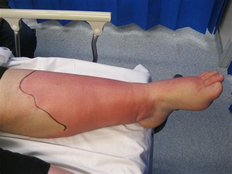 Cellulitis: Treatment, types and symptoms