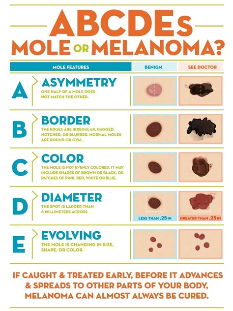 What is Melanoma? Learn the ABCDE of Moles