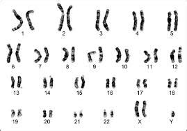 Klinefelters Syndrome Karyotype