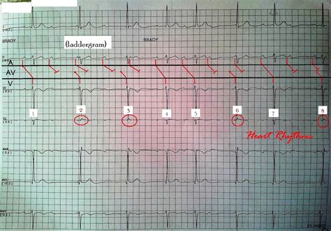 ECG Rhythms: Complete Heart Block or Not?