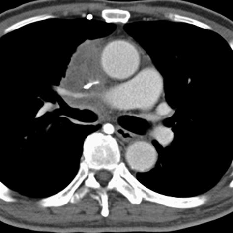 Mediastinal Lymphadenopathy, Lung Cancer (Chest CT) [3 of 3]