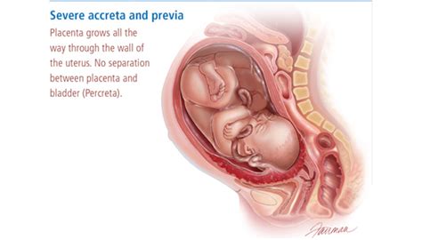 Placenta Accreta Pregnancy Complication - Brigham and Women's Hospital