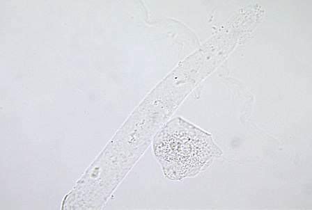 Types Of Casts Found In Urine And Their Clinical Significance | LaboratoryInfo.com