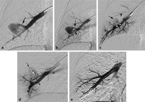 Covered Stents in the Treatment of Pulmonary Arteriovenous Malformations - Journal of Vascular ...