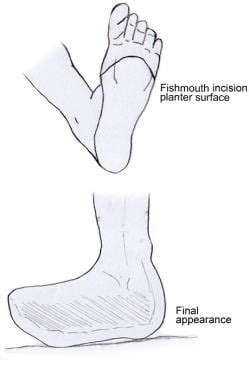 Transmetatarsal Amputation Technique: Transmetatarsal Amputation, Postoperative Care, Complications