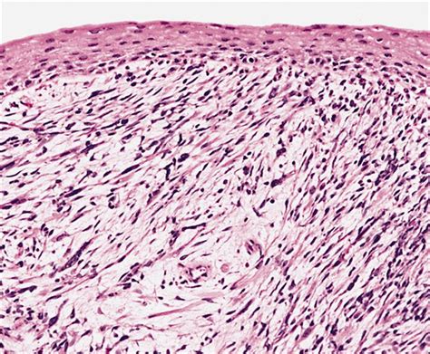 Rhabdomyosarcoma pathophysiology - wikidoc