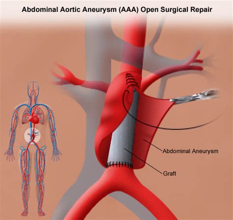 Abdominal Aortic Aneurysm Open Repair | Stanford Health Care