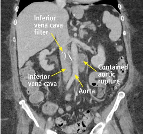 Back pain as a sign of inferior vena cava filter complications | Cleveland Clinic Journal of ...