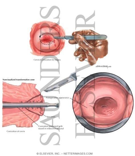 Conization; Conisation