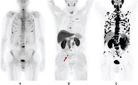 Frontiers | PSMA PET in Imaging Prostate Cancer