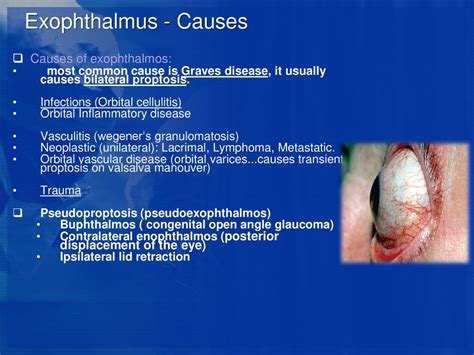 Bilateral Proptosis