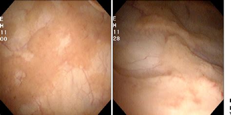 [PDF] Malakoplakia in the Urinary Bladder | Semantic Scholar