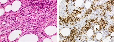 Bone marrow trephine biopsy from a patient with multiple myeloma showing a heavy infiltrate of ...