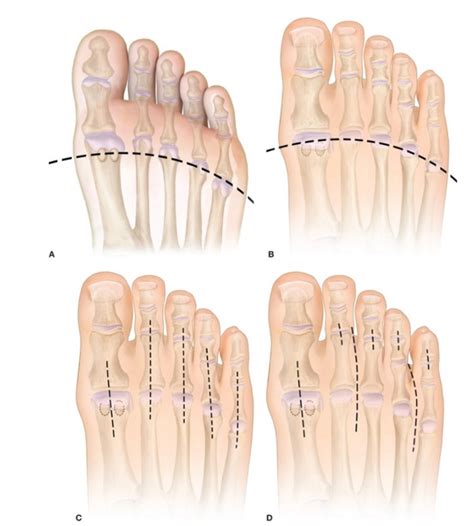 Master Techniques in Surgery: Foot Sparing-Amputations - DF Blog