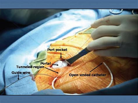 Quia - Class Page - Port Access Course: Surgical Implantation