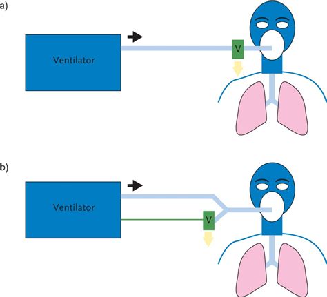 Choosing a ventilator for home mechanical ventilation | European Respiratory Society