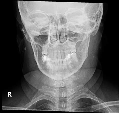 Parotid Duct