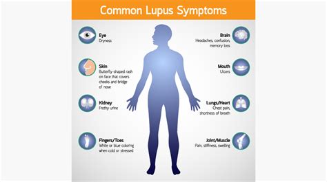 Lupus - Arthritis Treatment Center