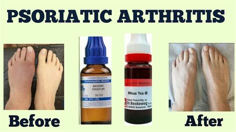 PSORIATIC ARTHRITIS(सोराइटिक अर्थराइटिस)TREATMENT - YouTube