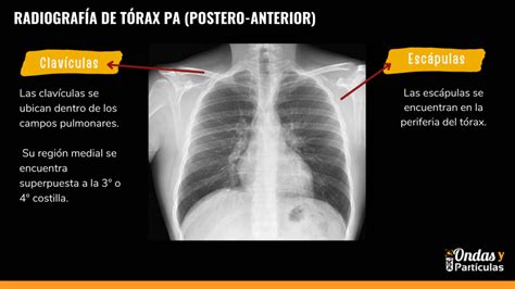 Radiografia De Torax Pa - Image to u