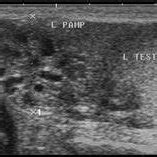 Ultrasound image of pampiniform plexus :(A) anechoic black circular... | Download Scientific Diagram