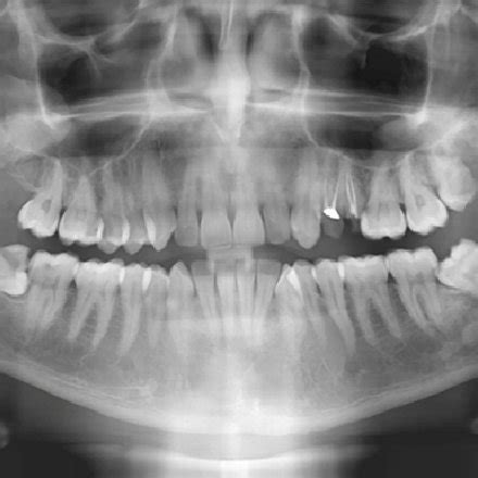 Antrolith. Periapical radiograph demonstrates an antrolith in the... | Download Scientific Diagram