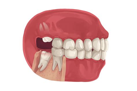 What Happens if You Don’t Remove Your Wisdom Teeth? - Prosper, TX