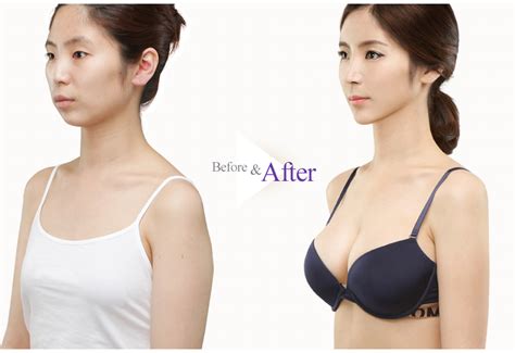 Breast Augmentation Before And After A To D