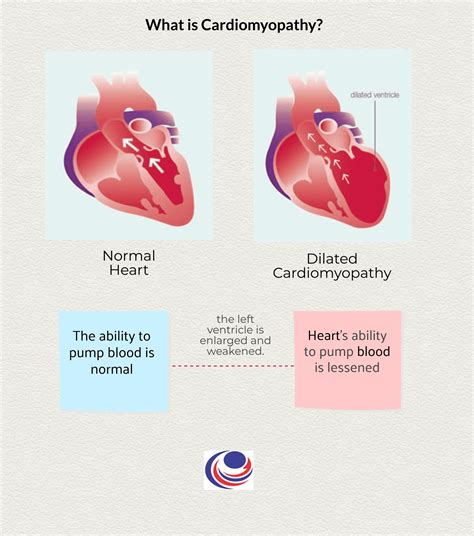 Dilated Cardiomyopathy