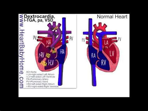 dextrocardia – Dictionary definition of dextrocardia | Encyclopedia.com: FREE online dictionary