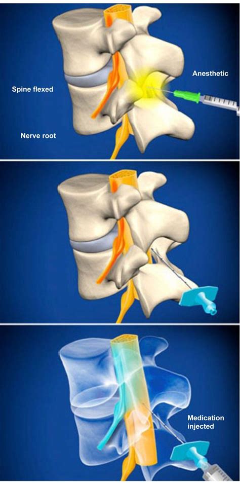 Lumbar Epidural Steroid Injection (without contrast) - Plano, TX: Advanced Spine Center