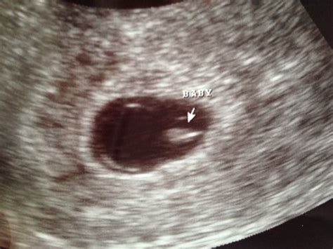 Spotting so got early ultrasound, 2 weeks off of LMP! *ultrasound pic* | BabyCenter