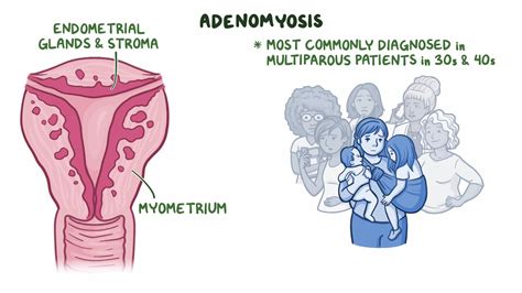 Adenomyosis: Clinical sciences - Osmosis Video Library