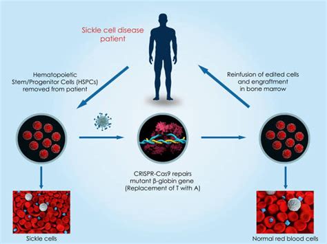 CRISPR Sickle Cell Gene Therapy: Approaches, Challenges, and Progress