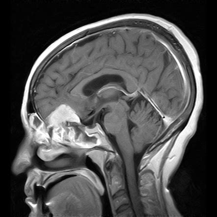 Planum sphenoidale meningioma | Radiology Case | Radiopaedia.org