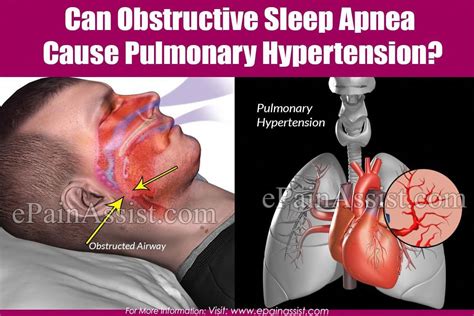 Pin on How to treat sleep apnea