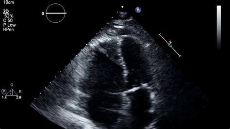 mcconnell sign Mcconnell pulmonary embolism bmj casereports - IMAGE FLUENT