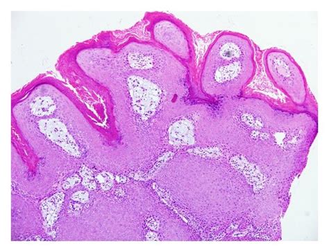 Verrucous hyperplasia: low power magnification view showing epidermal... | Download Scientific ...