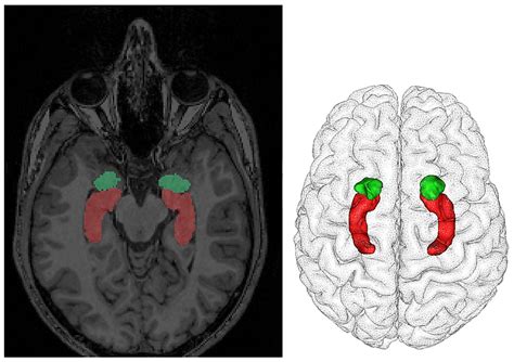 Amygdala Mri Sagittal