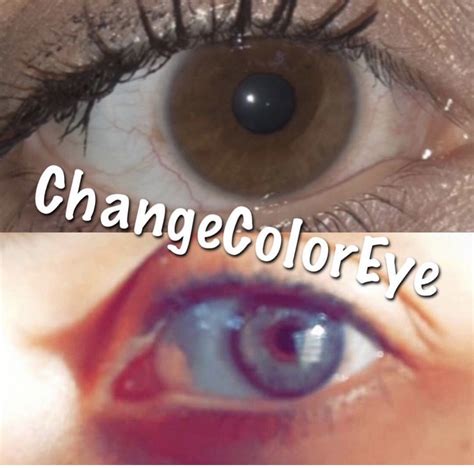 laser eye color change turkey - Floretta Large