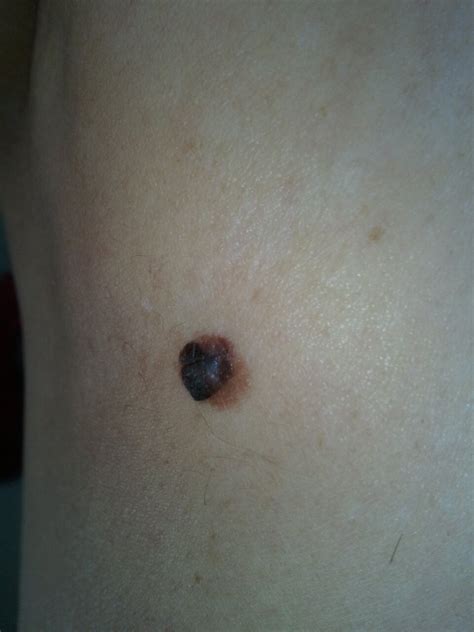 Melanoma Sucks!: Replay of Melanoma Surgery and Healing Pictures