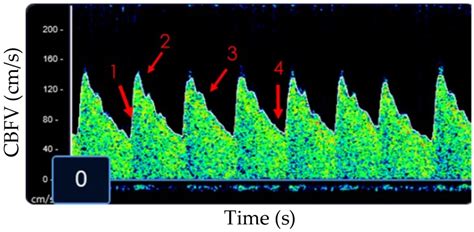 Children | Free Full-Text | Transcranial Doppler Ultrasound, a Review for the Pediatric Intensivist