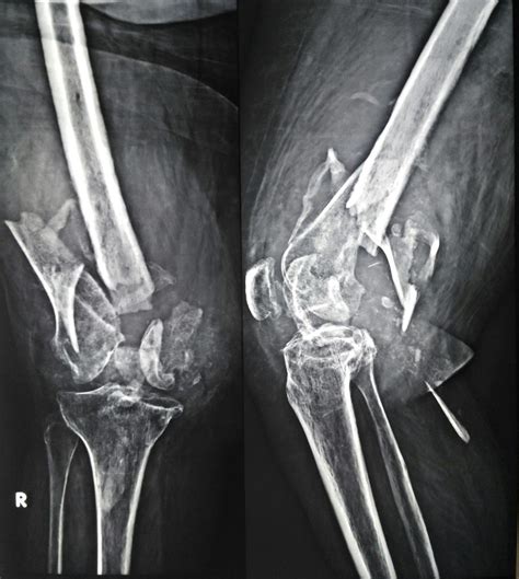 Distal Femur Fractures Trauma Orthobullets | Free Nude Porn Photos