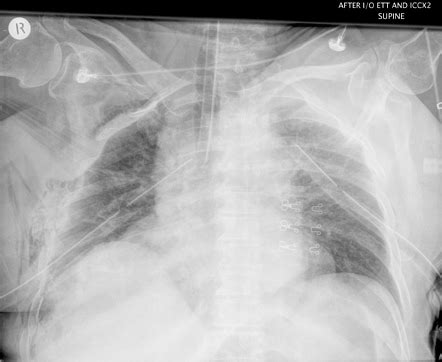 Apical Pleural Thickening