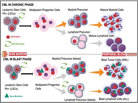 Cureus | The Progression of Chronic Myeloid Leukemia to Myeloid Sarcoma ...