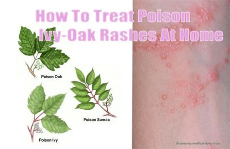 15 Reliable Home Remedies to Get Rid of Poison Ivy–Oak–Sumac Rashes