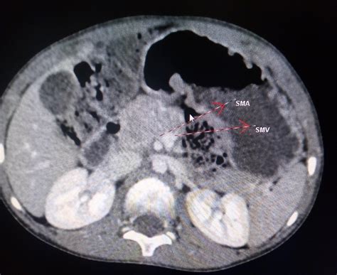 Midgut Volvulus CT - Sumer's Radiology Blog