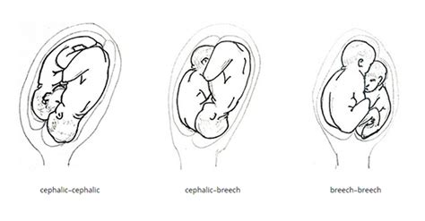 Delivery of Twins | Article | GLOWM