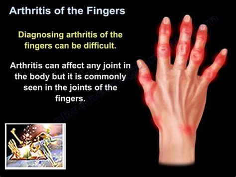 Arthritis Of The Fingers - Everything You Need To Know - Dr. Nabil Ebraheim - YouTube