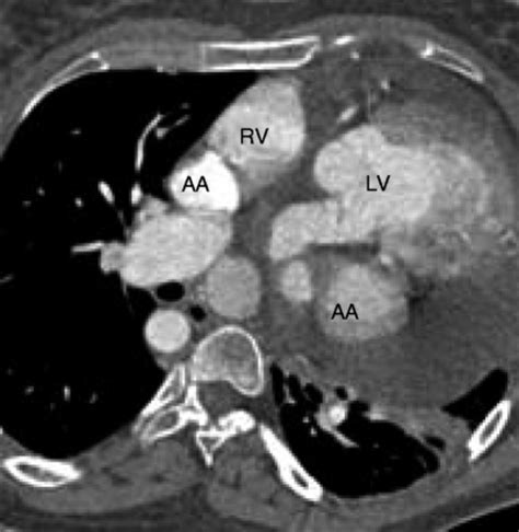 Heterotaxy Syndrome | Radiology Key